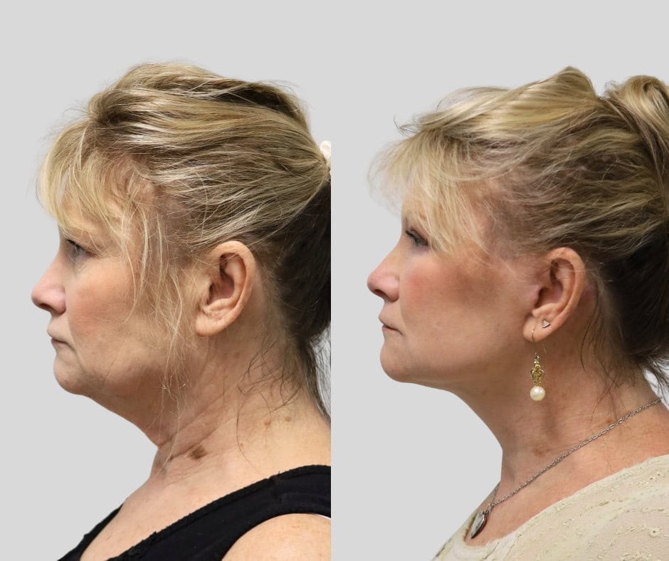 Before and after: 55-year-old patient, deep plane facelift and neck lift with fat grafting, upper blepharoplasty and periocular laser, 1 year post-op