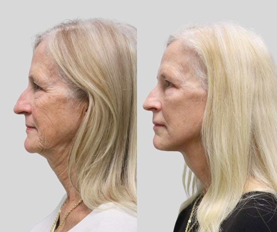 Before and after: 65-year-old patient, deep plane facelift and neck lift with fat grafting and temporal brow lift, 6 months post-op
