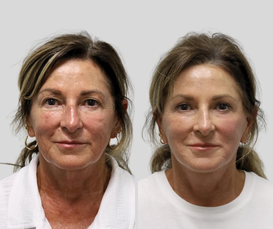 Before and after: 68-year-old patient, deep plane facelift and neck lift with upper blepharoplasty, 6 months post-op