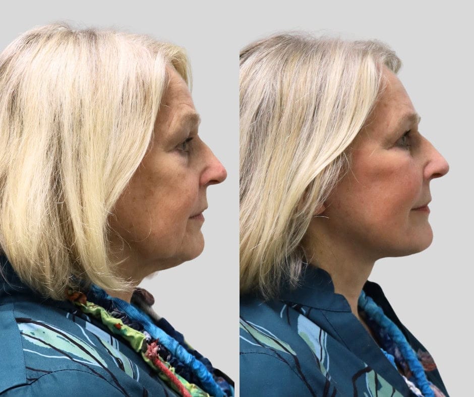 Before and after: 75-year-old patient, deep plane facelift and neck lift with temporal brow lift, upper blepharoplasty and periocular fat grafting, 6 months post-op